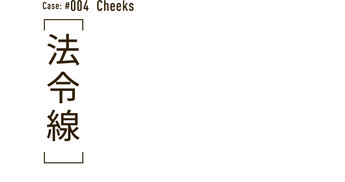 Case: #004  Cheeks 法令線