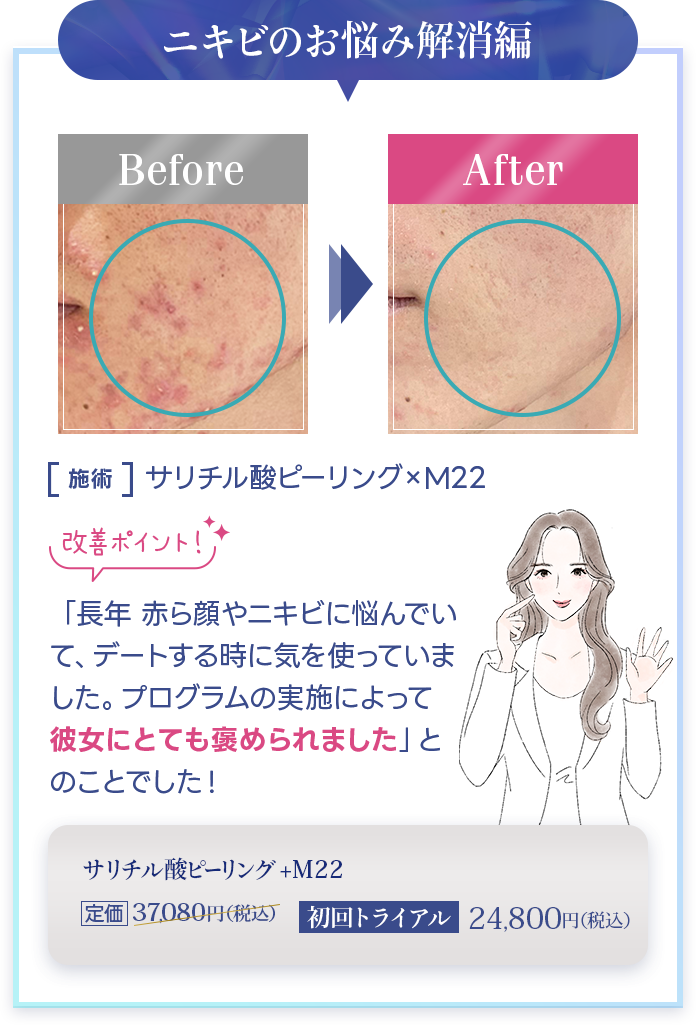 ニキビのお悩み解消編  