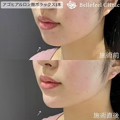 額ヒアルロン酸丸い額で印象若返り。施術前後の画像。