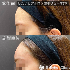 額こめかみヒアルロン酸ボリューマ7本。施術前後の画像。