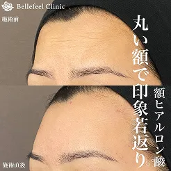 額こめかみヒアルロン酸ボリューマ7本。施術前後の画像。