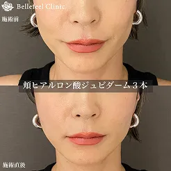ひたいヒアルロン酸ボリューマ3本。施術前後の画像。