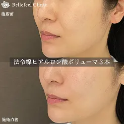 ひたいヒアルロン酸ボリューマ5本。施術前後の画像。