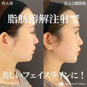 脂肪溶解注射 カベリン 両頬６本 顎下３本 Bellefeel Clinic