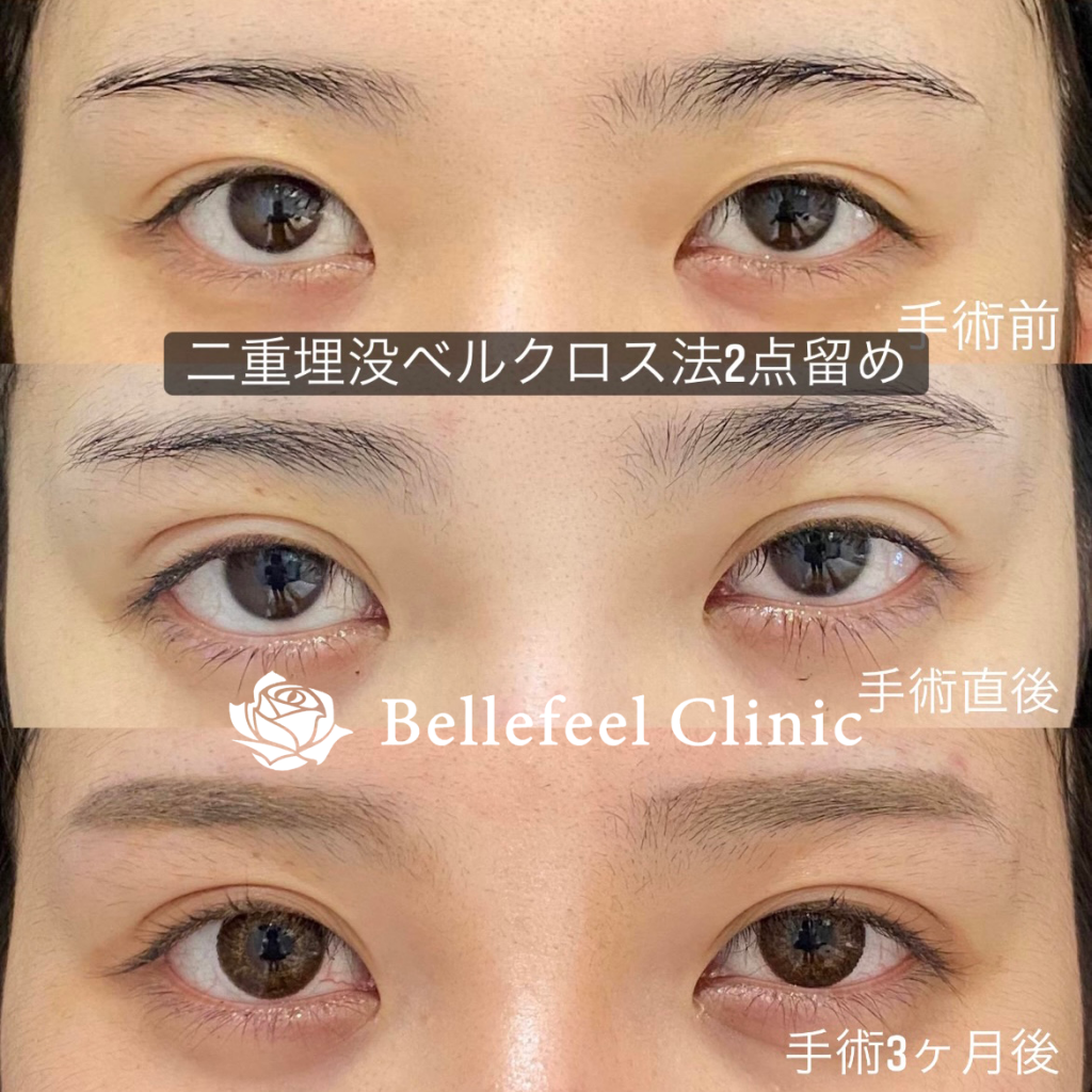 二重埋没ベルクロス法】2点留め | Bellefeel Clinic