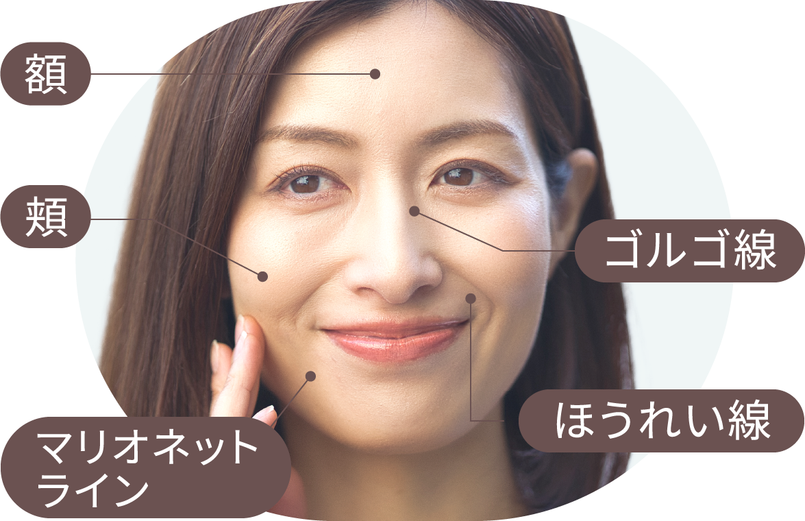 額 頬 ゴルゴ線 マリオネットライン ほうれい線