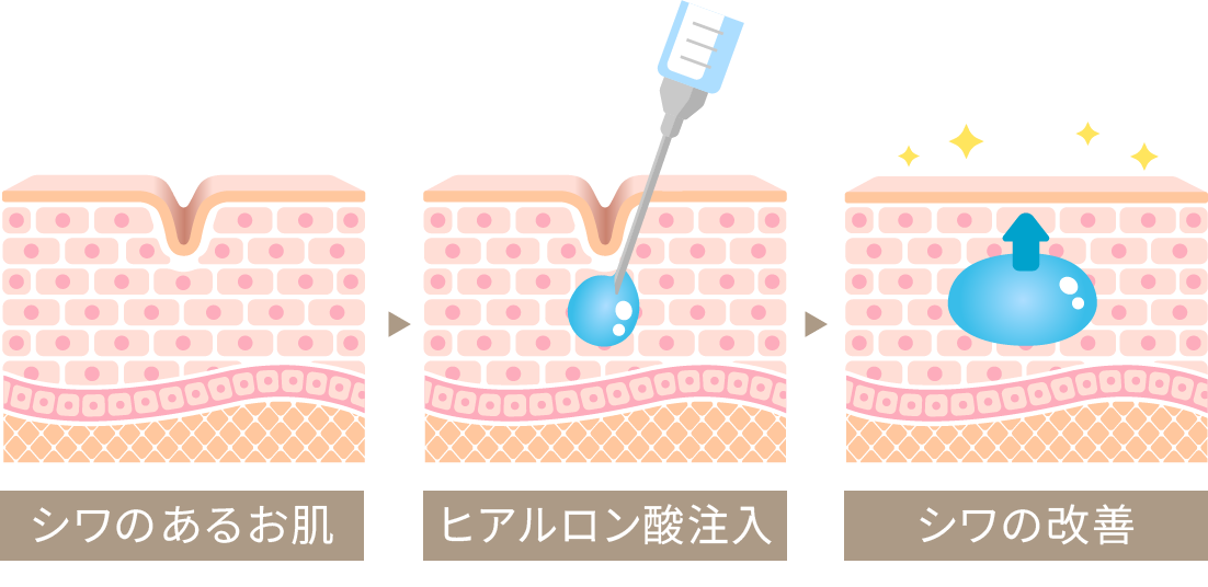 シワのあるお肌 ヒアルロン酸注入 シワの改善