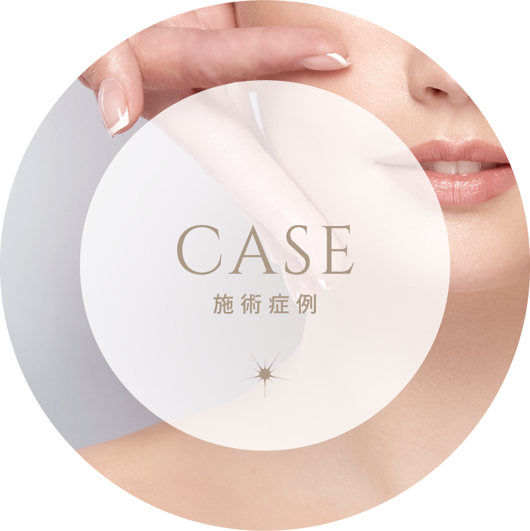 CASE