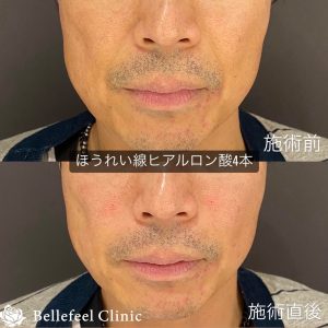【ほうれい線】ヒアルロン酸注入（ジュビダームビスタ　ボリューマXC）4本