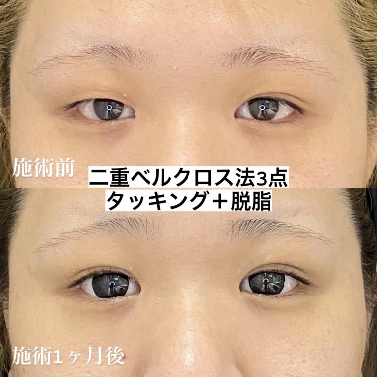 【二重埋没ベルクロス法】3点留め+タッキング+脱脂(1か月後)