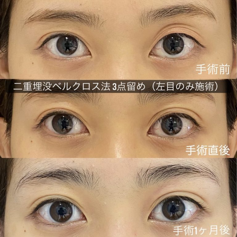 【二重埋没ベルクロス法】３点留め 左眼のみ（２ヵ月後）