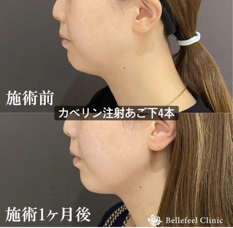 【脂肪溶解注射】カベリン あご下4本