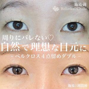 【二重埋没ベルクロス法】4点留めダブル（1週間後）