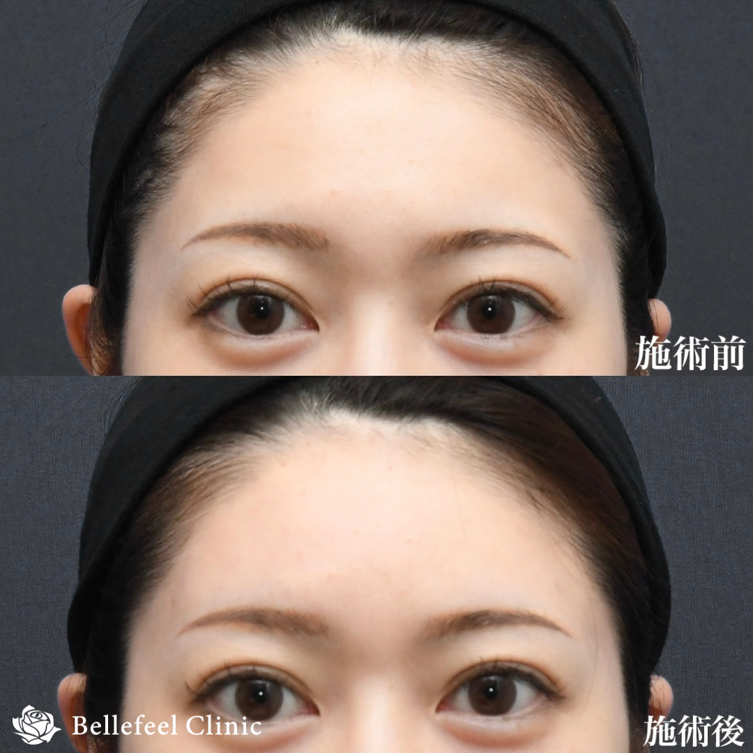 ヒアルロン酸 注入【額】