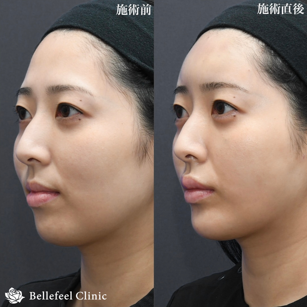 ヒアルロン酸 注入【カスタマイズ】