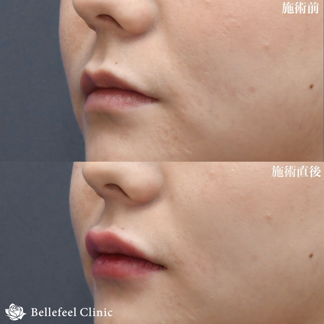 ヒアルロン酸 注入【口唇】