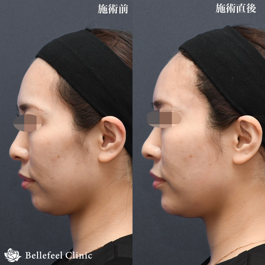 ヒアルロン酸 注入【顎】