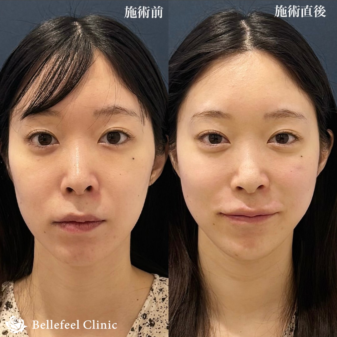 ヒアルロン酸 注入【カスタマイズ】