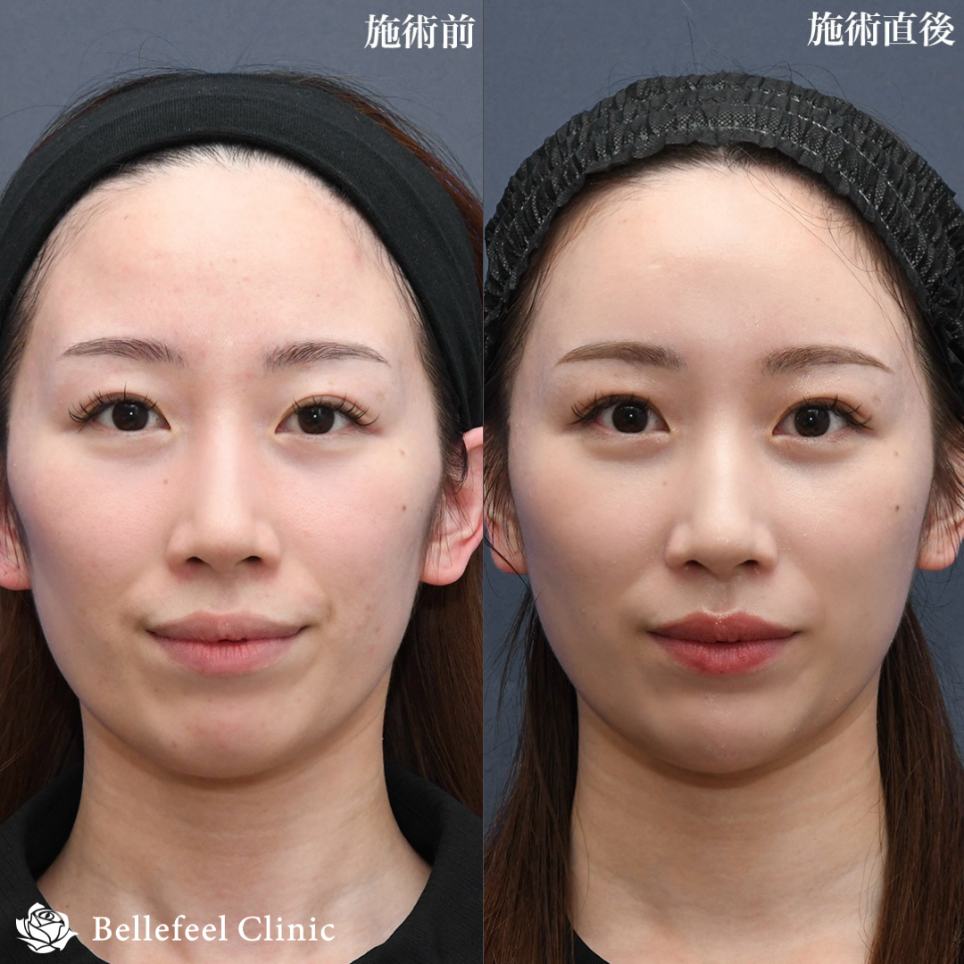 ヒアルロン酸 注入【カスタマイズ】