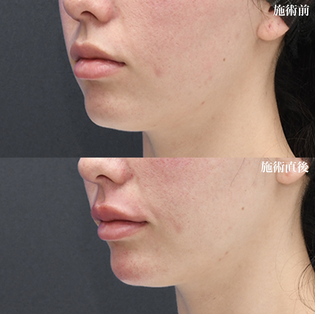 ヒアルロン酸 注入【顎】