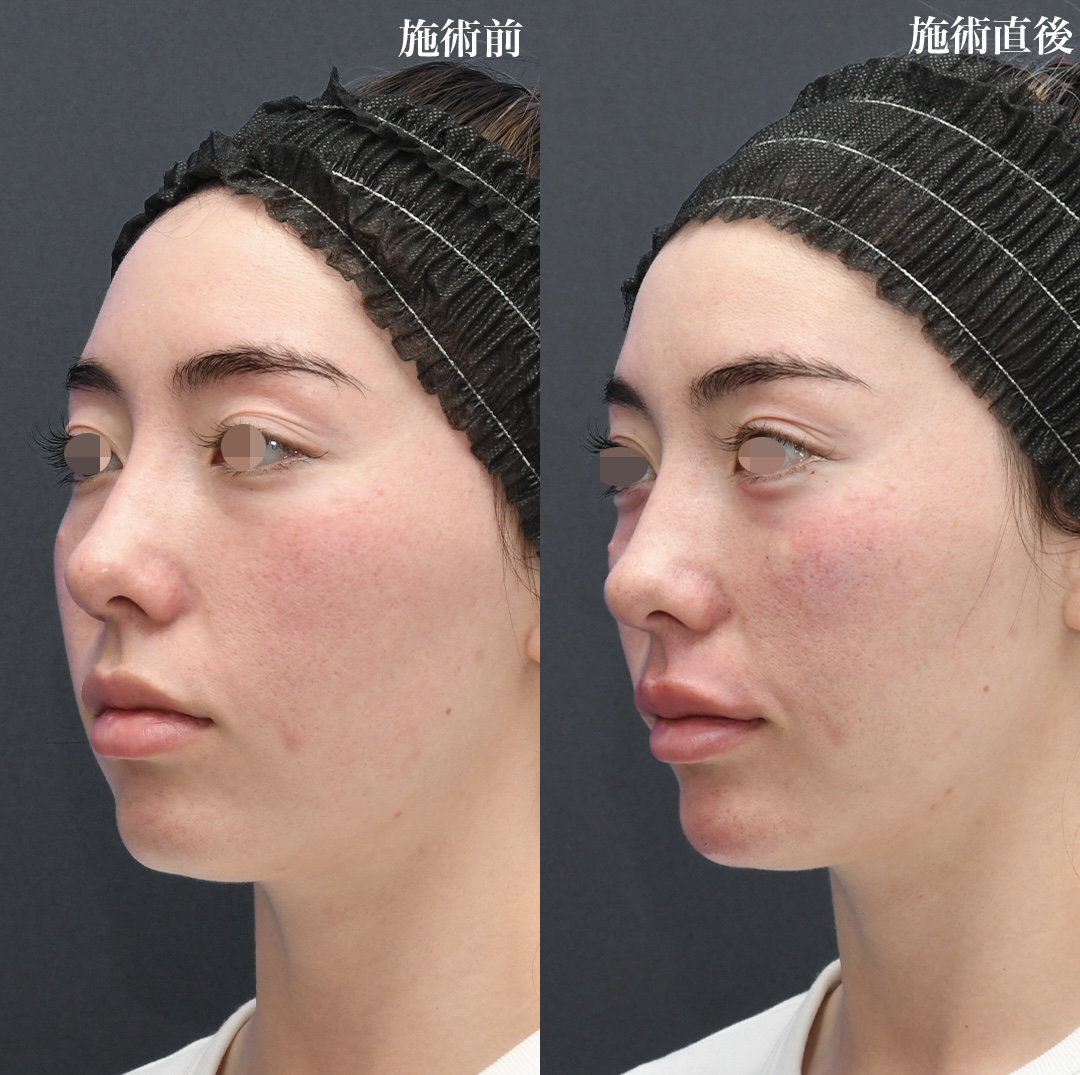 ヒアルロン酸 注入【カスタマイズ】