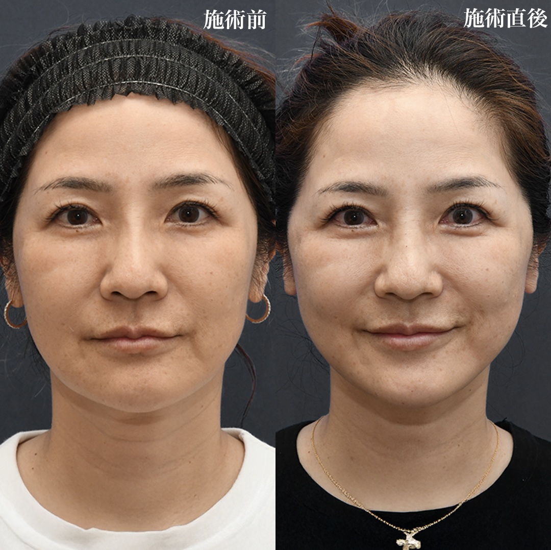 糸リフト【ヴィーナスリフト】