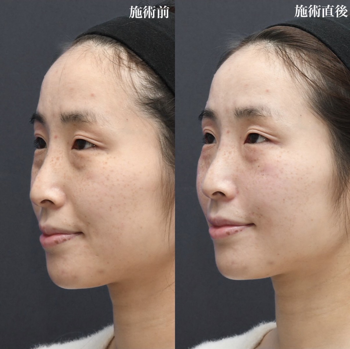 ヒアルロン酸 注入【法令線】