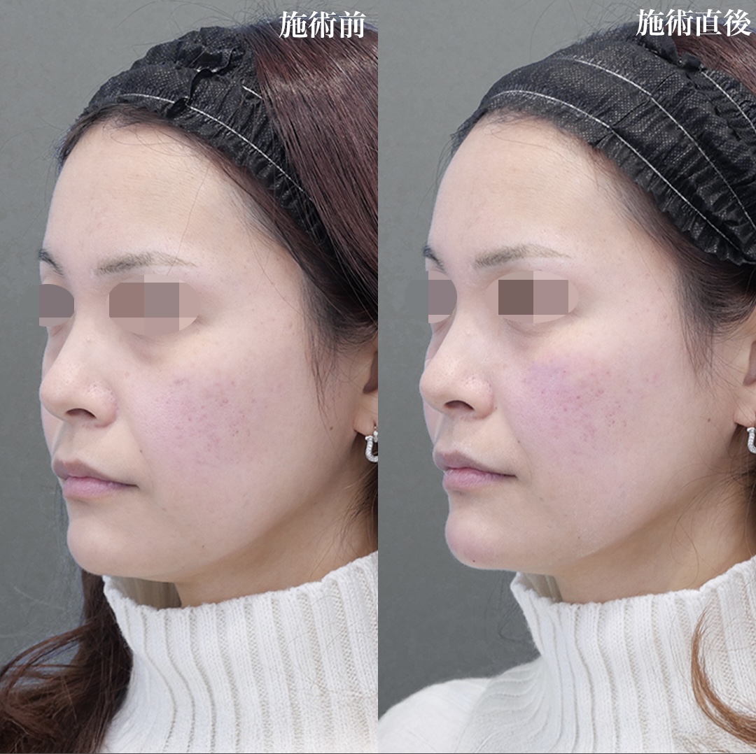 ヒアルロン酸 注入【カスタマイズ】