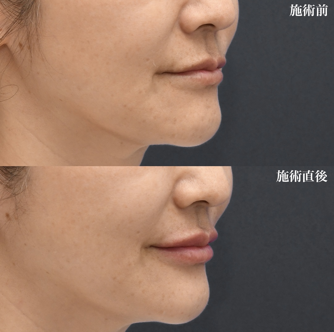 ヒアルロン酸 注入【口唇】