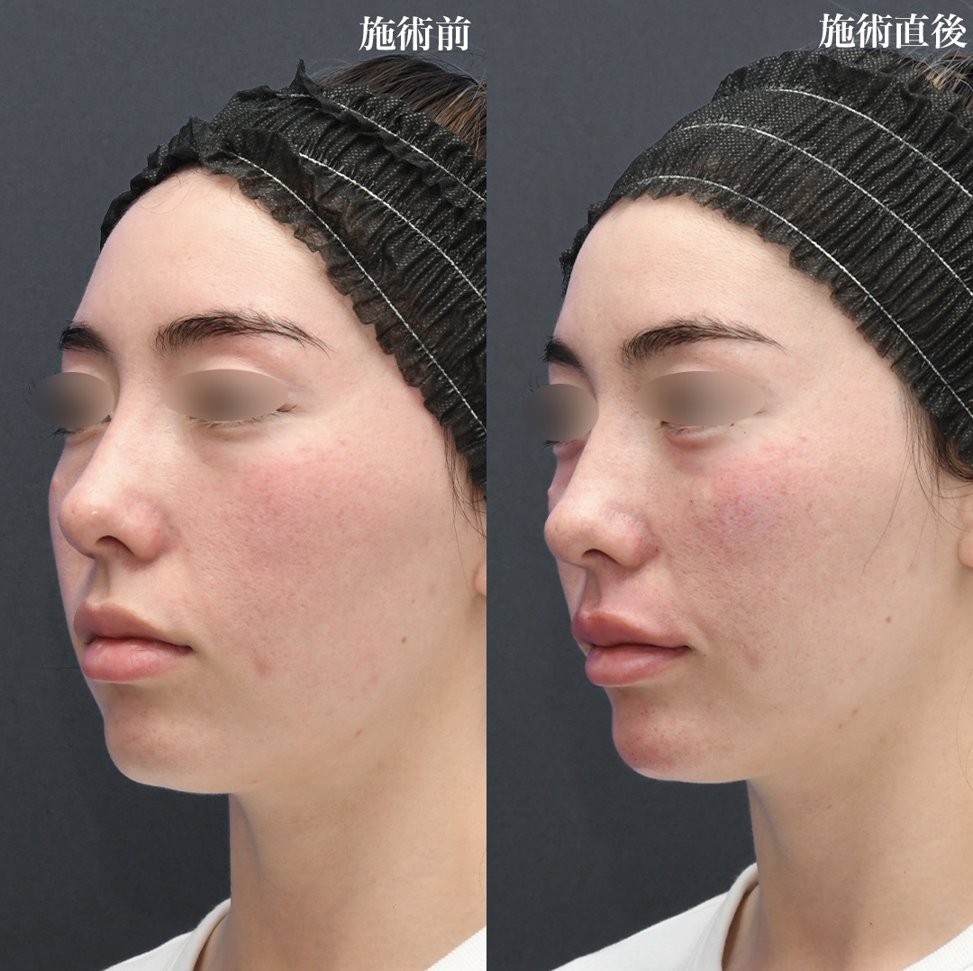 ヒアルロン酸 注入【カスタマイズ】