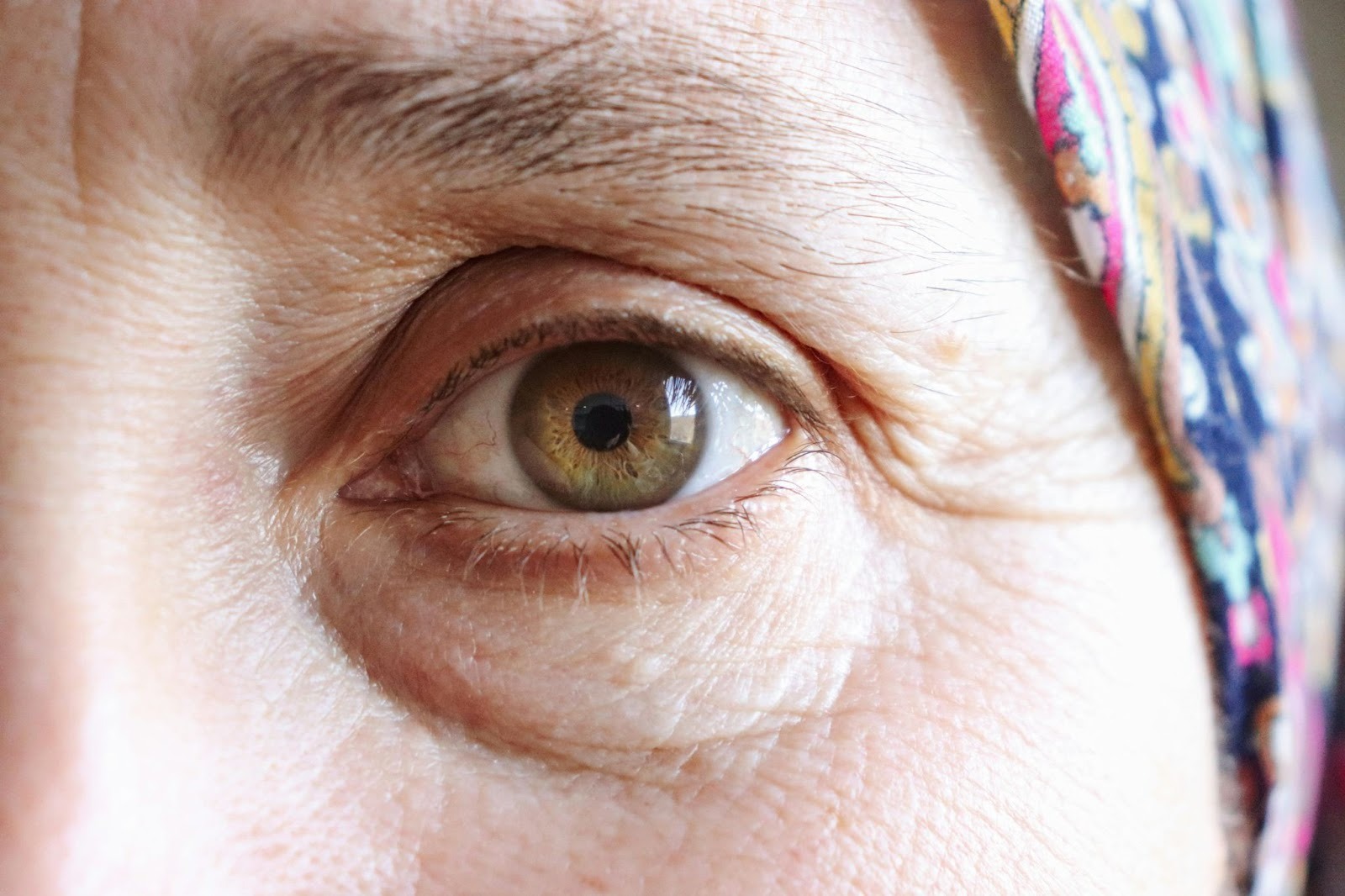 目の下のたるみを自力で治す方法｜知っておきたい原因と対策