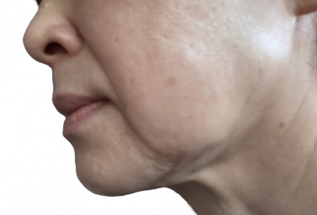 マリオネットラインとは何？30代から始めるセルフケアと美容医療